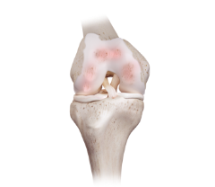 퇴행성 관절염 원인