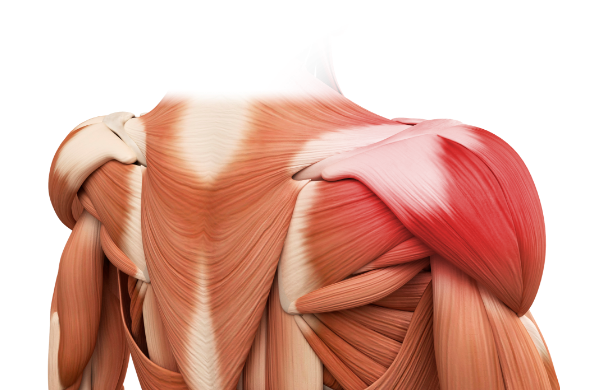 근막통증증후군